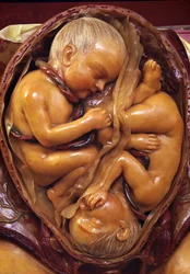 Model of twins in the womb